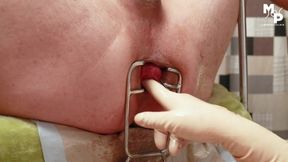 Speculum stretching for subs hole