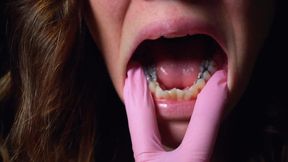 10 minutes Silver Fillings