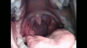 Endoscopic belching wmv