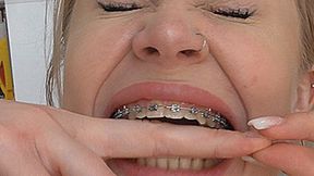 Bites her hands with her teeth with braces! MP4