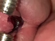 URETHRAL SOUNDING