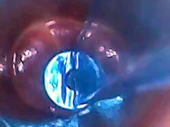 Endoscope POV: Test Tube Cock Urethral Insertion