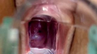 Cervix Closeup Using Speculum - See Inside Her Pussy