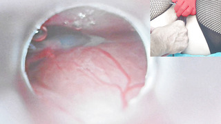 Insemination Cum into Uterus and Endoscope Camera by Cervix