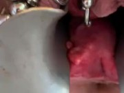 Double speculum 1
