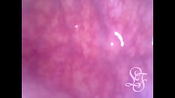 Anal Endoscope all the way in my Transverse Colon!