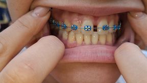 my imperfect teeth “Blue braces, bad girl vibe