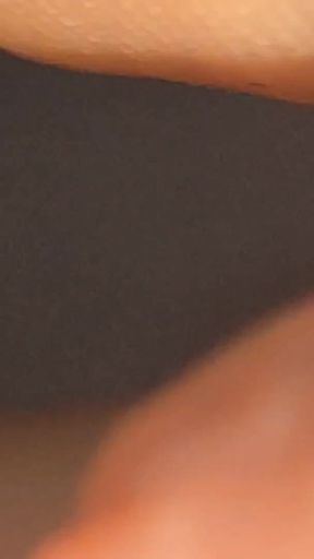 The Great Transformation of Phimosis Elastica.