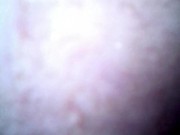 Vore POV with endoscope
