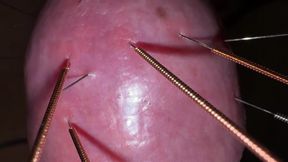 Acupuncture - Orgasm!