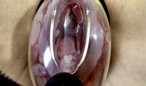 Vaginal Deformation Under the Influence of a Vacuum Pump