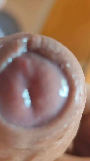 The Glans Appears Crowning Inside the Phimosis.