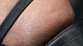 Foot and sandal fetish admiration, feet close-up skin details, heels, arched sole and toes.