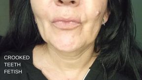 Crooked teeth fetish