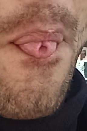 Sexy Mouth Complication