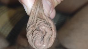 Detaching the Foreskin From the Glans Slowly.