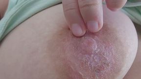 Oozing Nipple Close-Up: Suppurating Pus & Red Itch Reveal