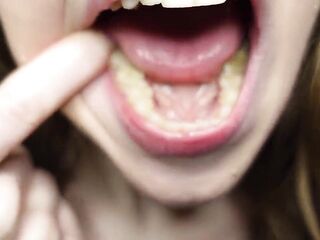 I Tell U About the Fillings in My Teeth and Dental Visits