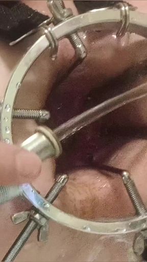 Enema, anal shower. Close-up view through anal mirror. Anal with water. Filling anal with water   Clip 2