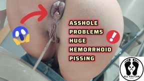 PISSING WITH A HUGE HEMORRHOID IN MY ASSHOLE ANAL PROBLEMS