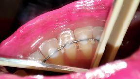 Permanent Retainers Mouth Tour