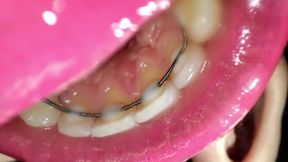 Permanent Retainers Mouth Tour