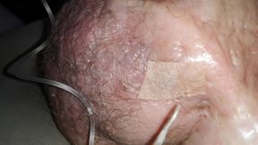 2liter glucose 'halfeway' of my double injection