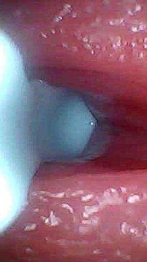 I Couldn’t Believe What Happens Inside the Penis as Sperm Passes Through (endoscopic Footage)