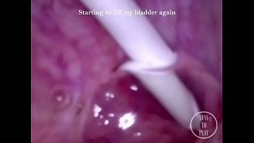 Can I fit the minicam AND a catheter inside my pee hole at the same time?