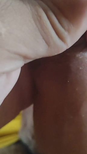Application of Instant Phimosis Remover.
