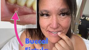Short Root Canal update: See my Oral Fistula and my tongue sticking out! (aug 29 2025)