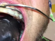 Horny deepthroat full of spit with braces and double headgear