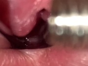 URETHRAL SOUNDING