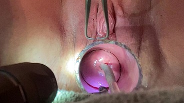 Frozen sound penetrates cervix with Tenaculum