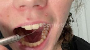 Sadistic Dental Cleaning with Explorer and Cavity Fillings 720p