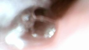 cherry tomatos endo stomach cam