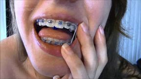 Embracing Braces