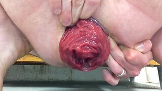 Extreme anal fisting: prolapsed holes and massive dildos - nr. 6 amateur ff action! tags: anal, fisting