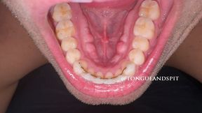 Andrew Bottom Teeth and Retainer Part19 Video1 - WMV