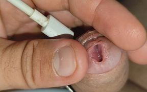 Electrical Pulsation Within the Glans with Rapid Excitation.