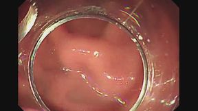 Endoscope Progression