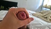 Have You Ever Seen Phimosis This Tight? Uncut Close Up