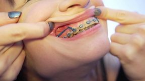 BRACES DIARY Showing my Braces with A Closeup Lens