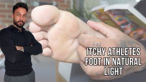 Itchy athletes foot in natural light - Lalo Cortez