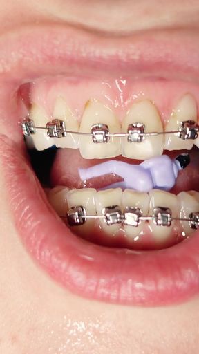 Giantess Devour Fetish in Braces