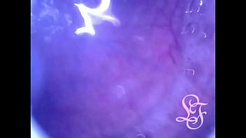 Pumping Air into my full Bladder with the Minicam inside