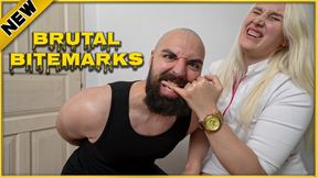 Aggressive Finger Biting: Brutl Bitemarks