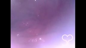 Anal Endoscope all the way in my Transverse Colon!