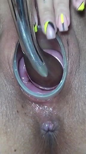 Extreme World Record for Cervix