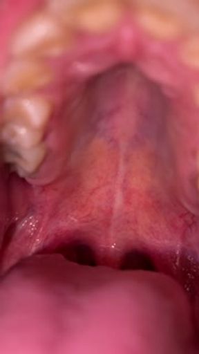 Old video without my braces